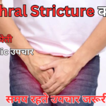 ayurvedic medicine for Urethral Stricture