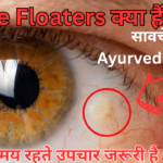 eye floaters ayurvedic medicine