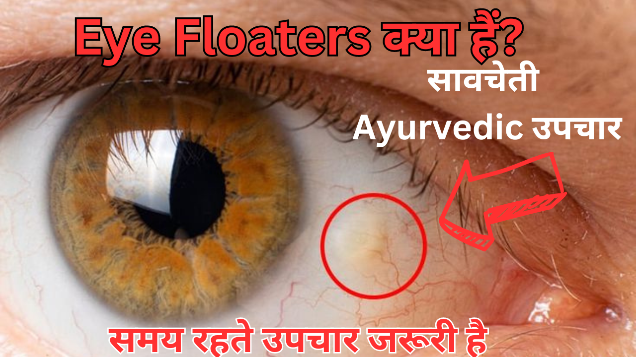 eye floaters ayurvedic medicine