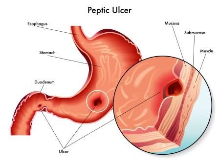 Peptic-Ulcer