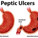 Peptic-Ulcer