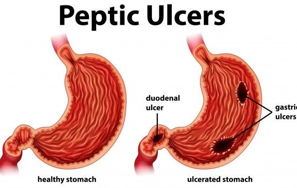 Peptic-Ulcer