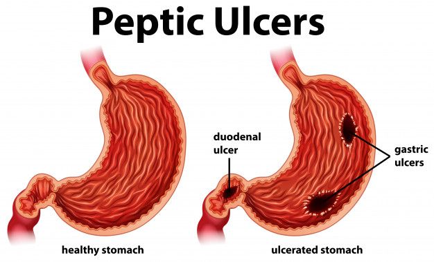 Peptic-Ulcer