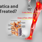 Ayurvedic Treatment for Sciatica